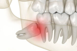 Best Wisdom Teeth Treatment in Mohali?