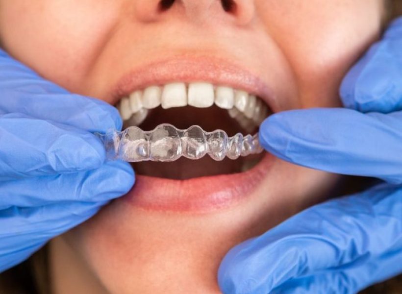 Invisible braces treatment in Mohali