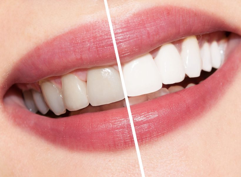 Teeth whitening Treatment